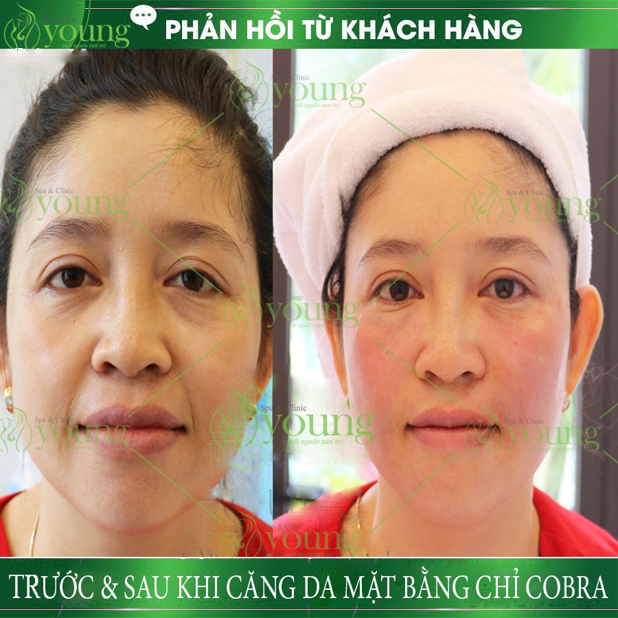 Review căng chỉ da mặt tại Young Spa & Clinic