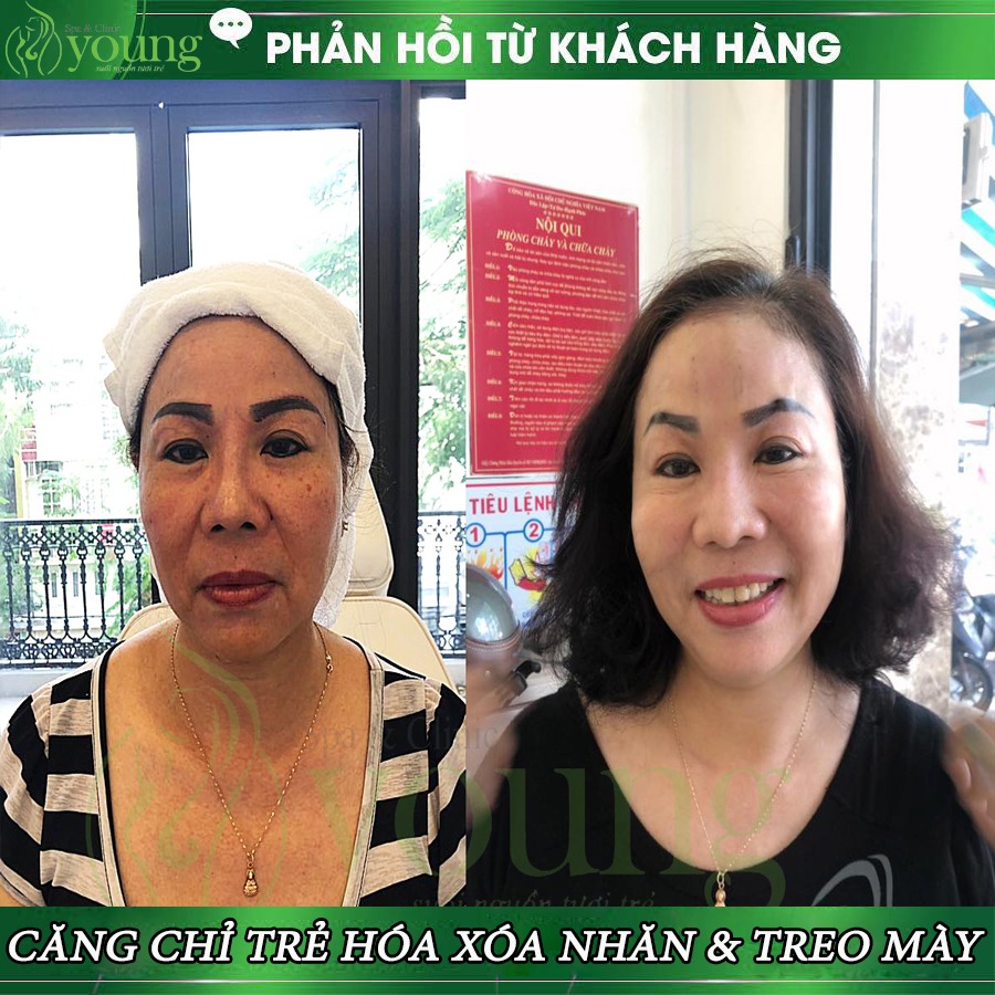 Review căng chỉ da mặt tại Young Spa & Clinic