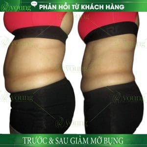 Kết quả điều trị giảm mỡ bụng tại Yong Spa