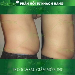 Kết quả điều trị giảm mỡ bụng tại Yong Spa