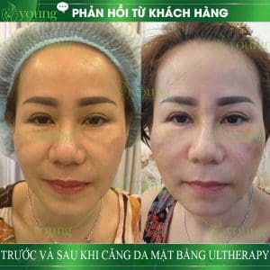 nang-co-mat-ultherapy