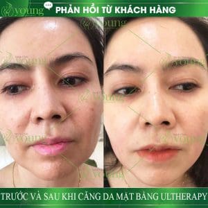 nang_co_mat_ultherapy
