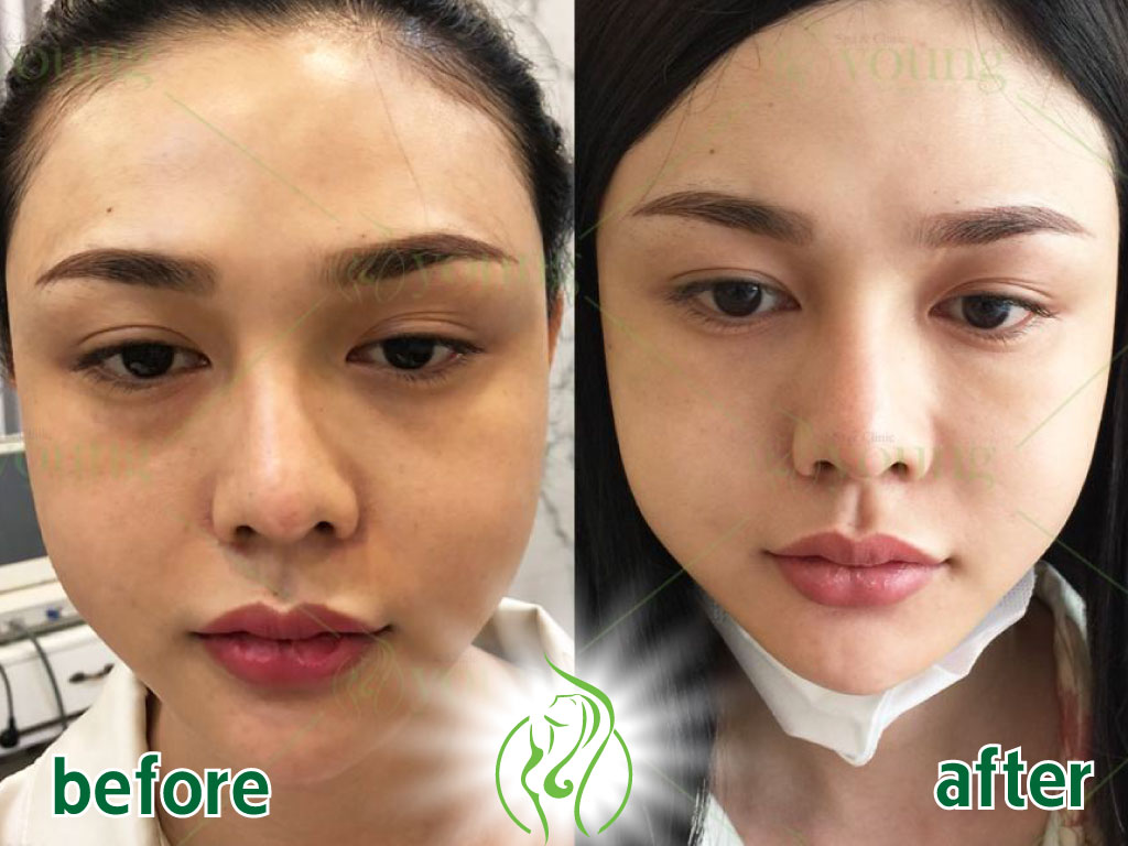 Kết quả điều trị thâm quầng mắt tại Young Spa