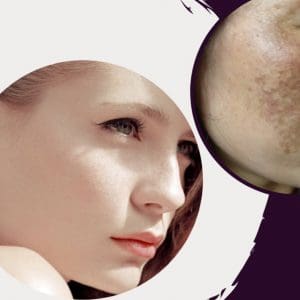 Điều trị nám da chỉ sau 1 liệu trình tại Young Spa