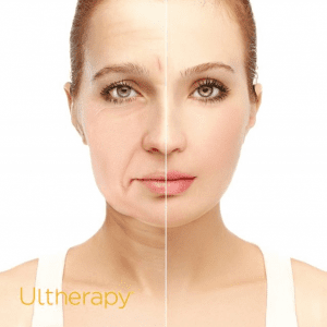 Công Nghệ Nâng Cơ Ultherapy Trẻ Hóa Làn Da tại Young Spa