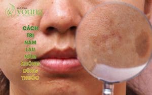 Cách trị nám tàn nhang lâu năm không cần dùng thuốc