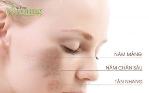 Các dấu hiệu da mặt bị nám tàn nhang
