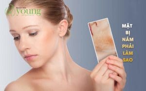 Mặt bị nám phải làm sao, các mẹo trị nám hiệu quả tại nhà
