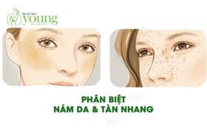 Phân biệt nám da và tàn nhang có điểm gì khác nhau?