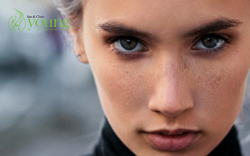 Phân biệt nám da và tàn nhang có điểm gì khác nhau?
