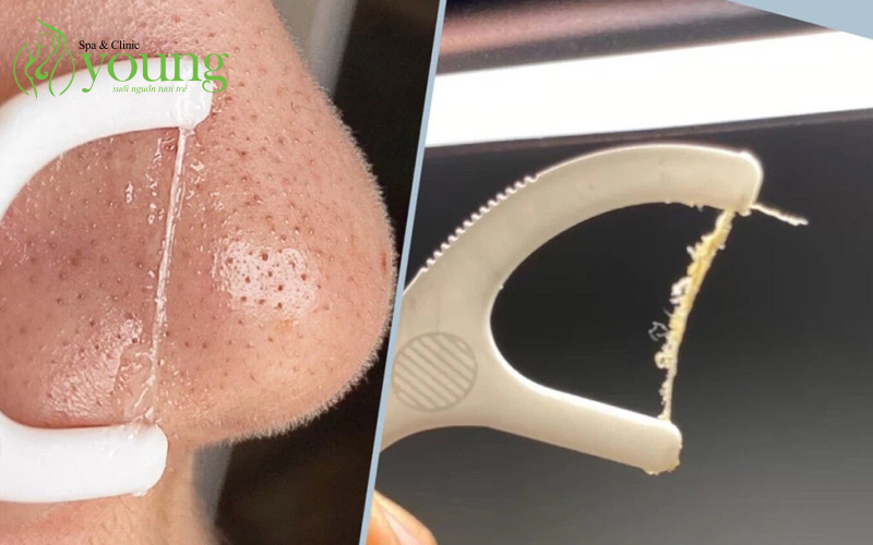 10 cách trị mụn đầu đen đơn giản tại nhà