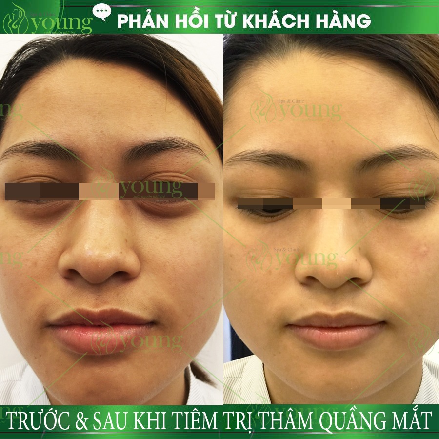cach-chong-tham-quang-mat-tai-nha-pho-bien-nhat