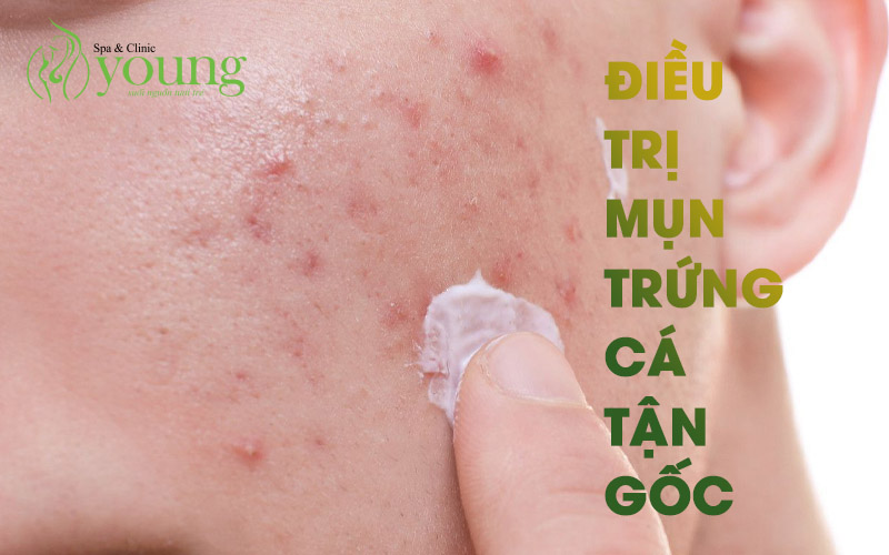 Trị mụn trứng cá tận gốc chỉ 1 liệu trình tại Young Spa & Clinic