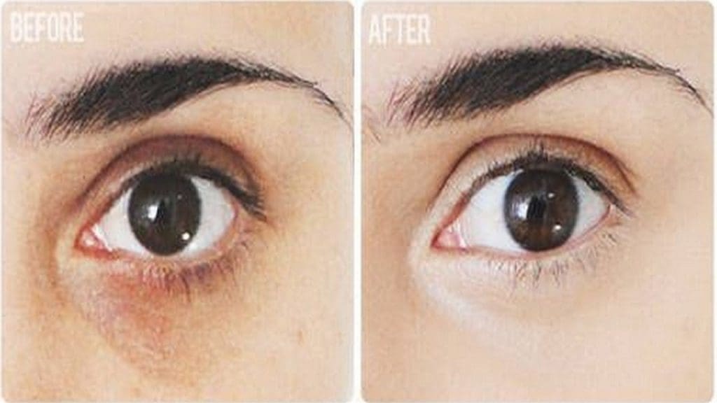 Cách trị quầng thâm mắt với phương pháp cổ truyền
