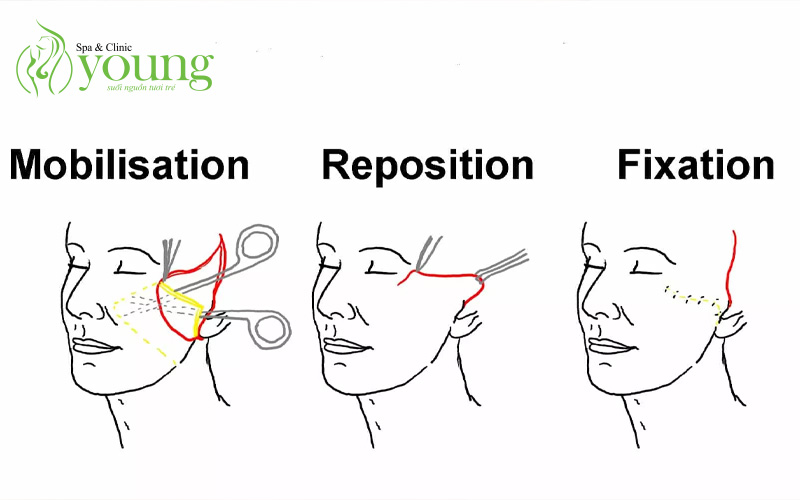 Căng chỉ collagen là gì? Các loại chỉ căng da an toàn