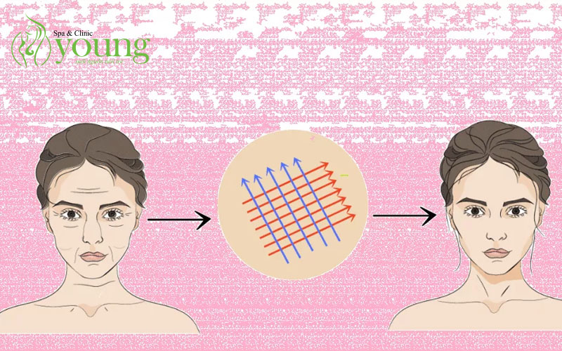 Căng chỉ collagen là gì? Các loại chỉ căng da an toàn