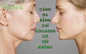 Căng da bằng chỉ collagen có tốt không?