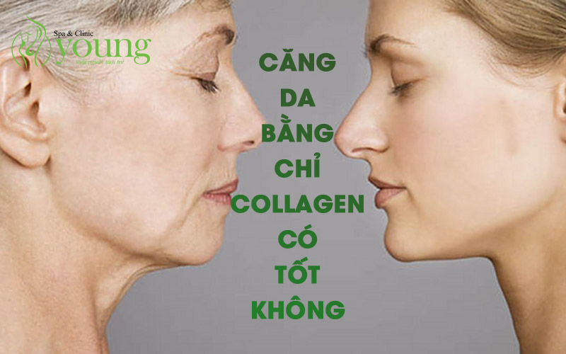 Căng da bằng chỉ collagen có tốt không?