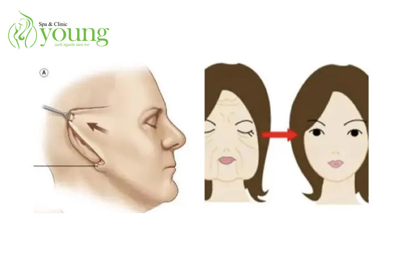 Căng da mặt bằng chỉ ở đâu tốt?