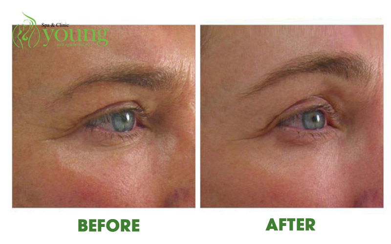 Công nghệ ultherapy? Căng da mặt không phẫu thuật là gì?