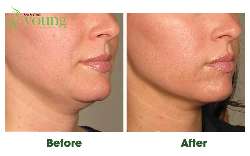 Công nghệ trẻ hóa làn da ultherapy tại Young Spa