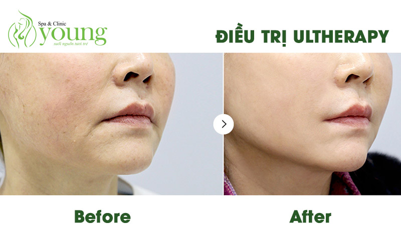 Công nghệ trẻ hóa làn da ultherapy tại Young Spa