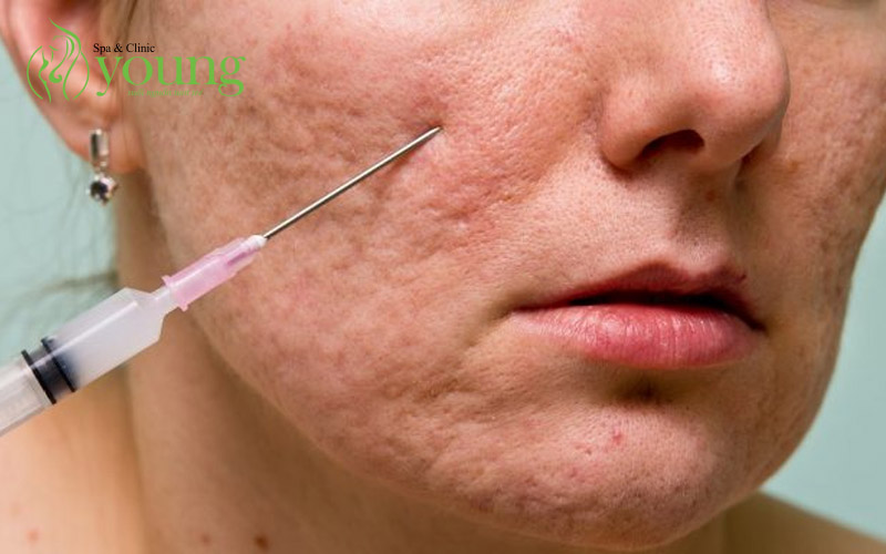 Điều trị sẹo rỗ bằng phương pháp nào tốt nhất?