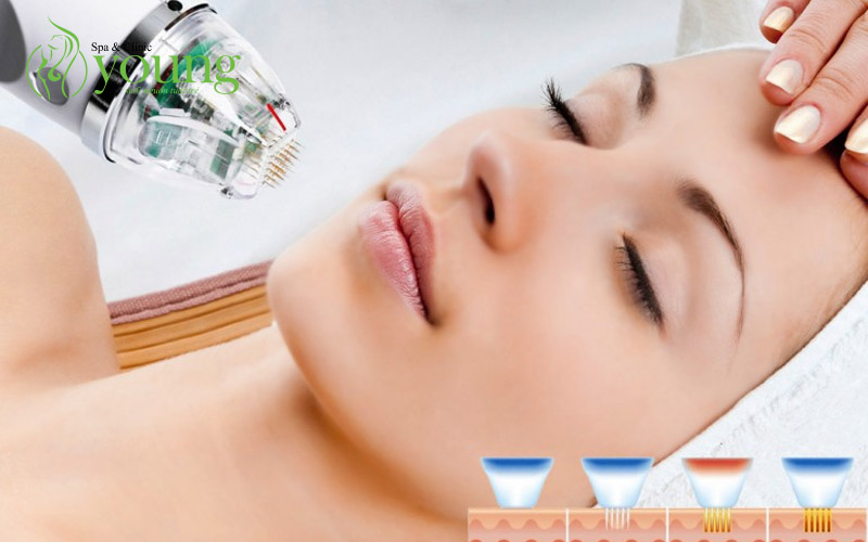 Điều trị sẹo rỗ bằng phương pháp nào tốt nhất?