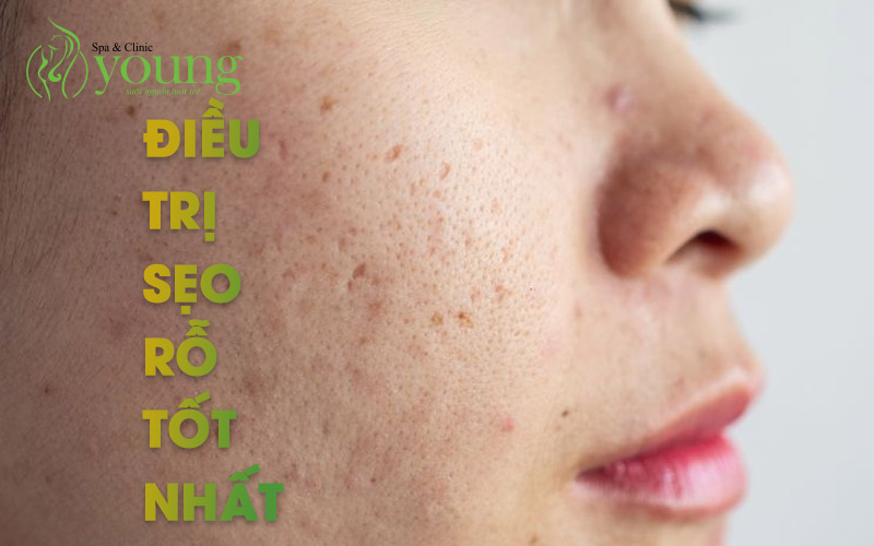 Điều trị sẹo rỗ bằng phương pháp nào tốt nhất?