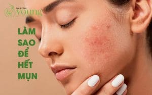 Làm sao để hết mụn, Spa nào uy tín tại Hồ Chí Minh điều trị mụn?