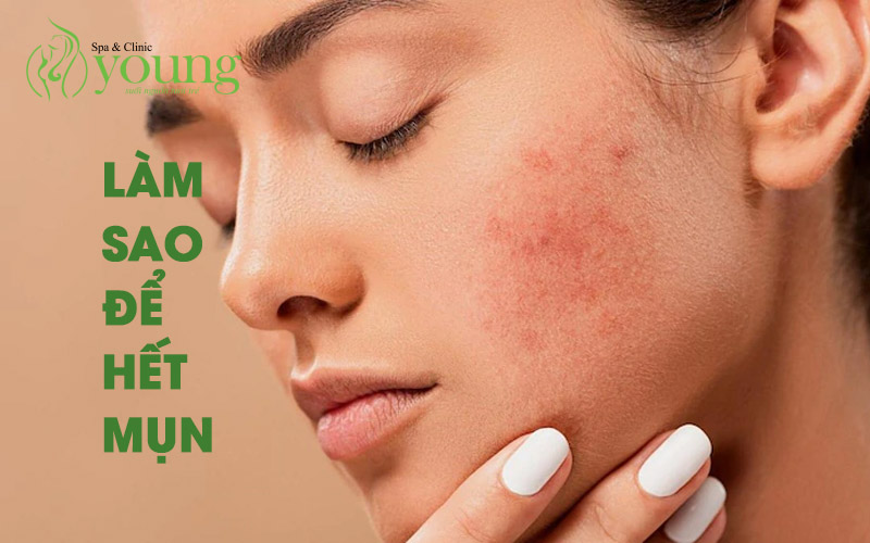 Làm sao để hết mụn, Spa nào uy tín tại Hồ Chí Minh điều trị mụn?