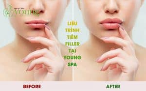 Liệu trình tiêm filler tại Young Spa hiệu quả