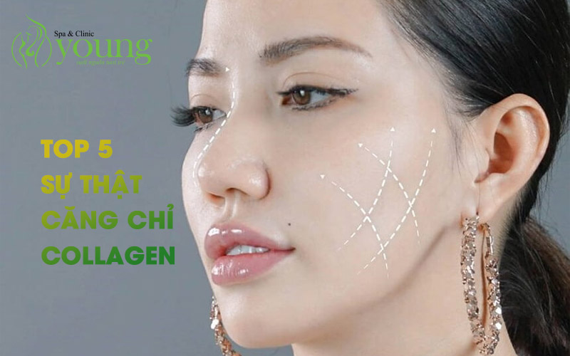 Top 5 sự thật về phương pháp căng da mặt bằng chỉ collagen