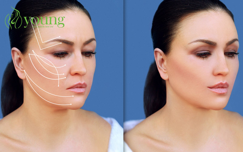 Top 5 sự thật về phương pháp căng da mặt bằng chỉ collagen