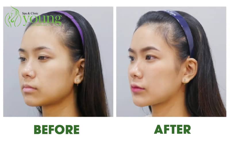 Tiêm filler độn cằm là gì ? Tiêm filler độn cằm giá bao nhiêu?