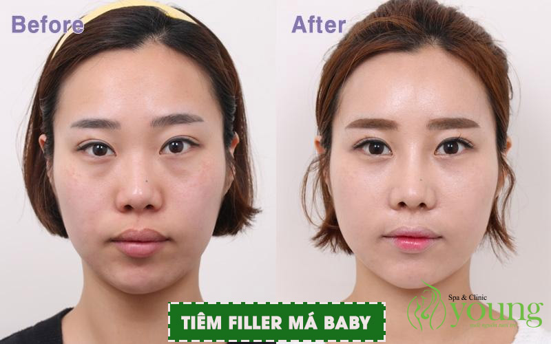 Tiêm filler má baby giá bao nhiêu, quy trình tiêm filler má baby tại Young Spa