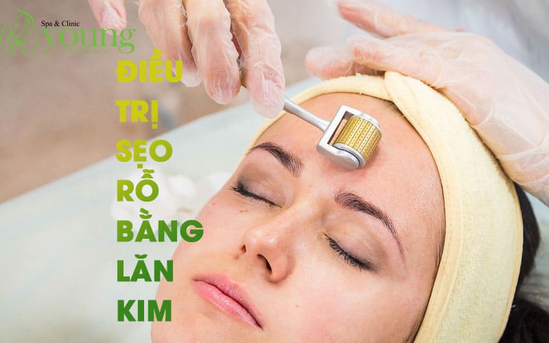 Điều trị sẹo rỗ bằng phương pháp lăn kim có gì?