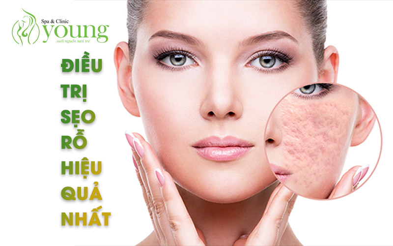 Điều trị sẹo rỗ bằng phương pháp nào hiệu quả nhất