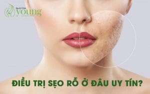 Những lưu ý sau khi điều trị sẹo rỗ, điều trị sẹo rỗ ở đâu uy tín