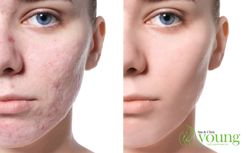 Spa điều trị sẹo rỗ uy tín, liệu trình điều trị sẹo rỗ tại Young Spa
