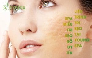 Spa điều trị sẹo rỗ uy tín, liệu trình điều trị sẹo rỗ tại Young Spa