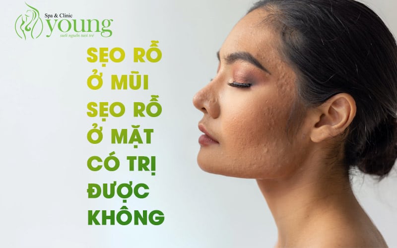 Sẹo rỗ ở mũi, sẹo rỗ ở mặt có điều trị được không?