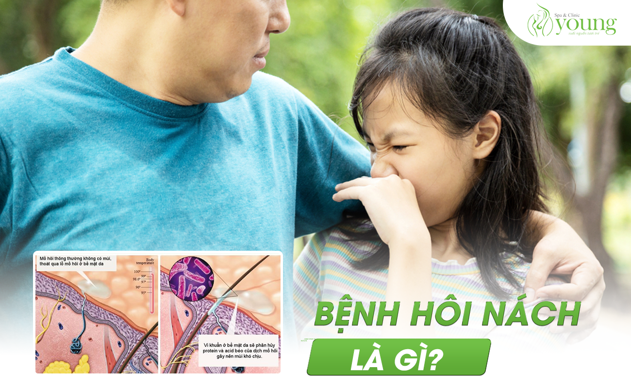 Bệnh hôi nách là gì?