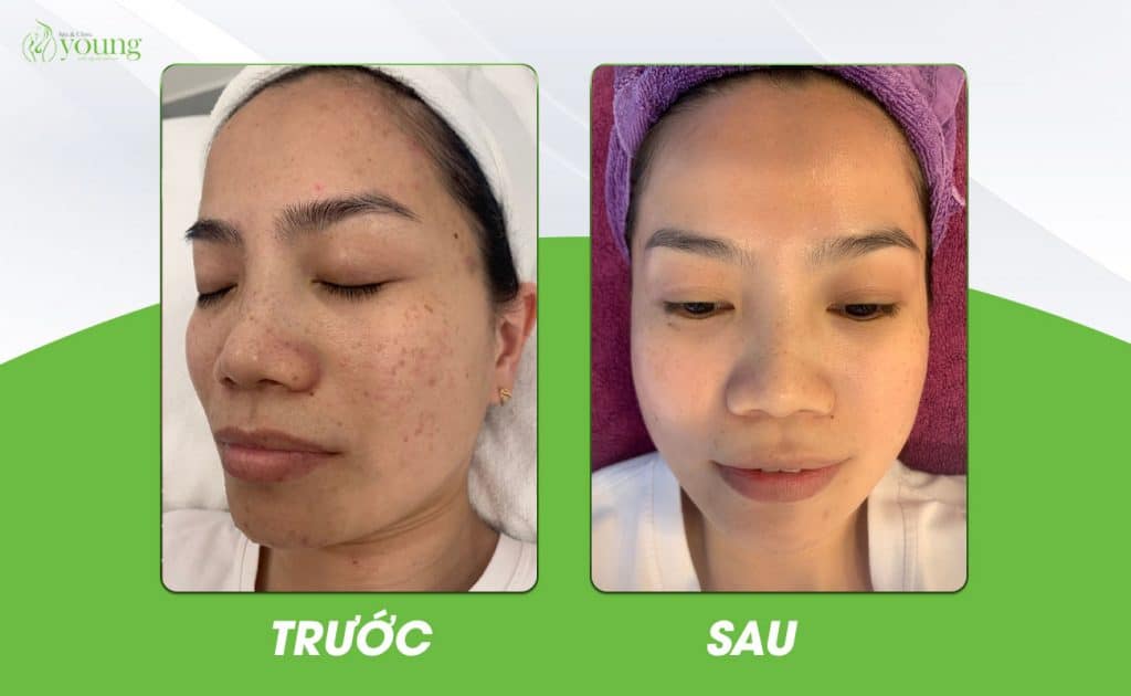 Điều trị mụn tại Young Spa